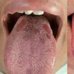 Сифилис во рту – как выглядит и чем он опасен?